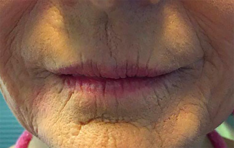 Lifting médical bas du visage apres le traitement